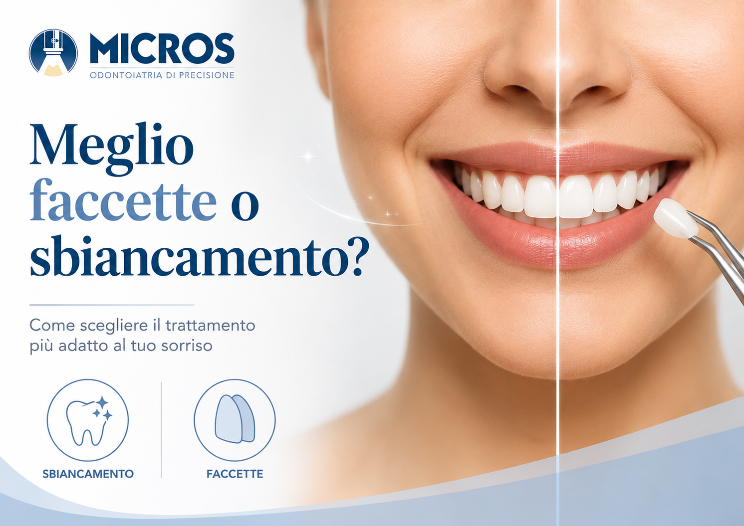Meglio faccette o sbiancamento?